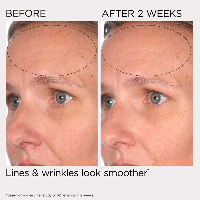 Before and after comparison of a person's face showing smoother lines and wrinkles after 2 weeks.